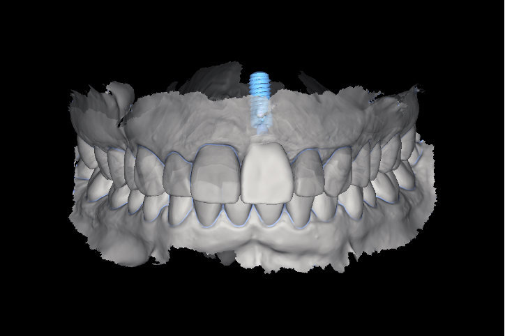 Implant Based Solutions