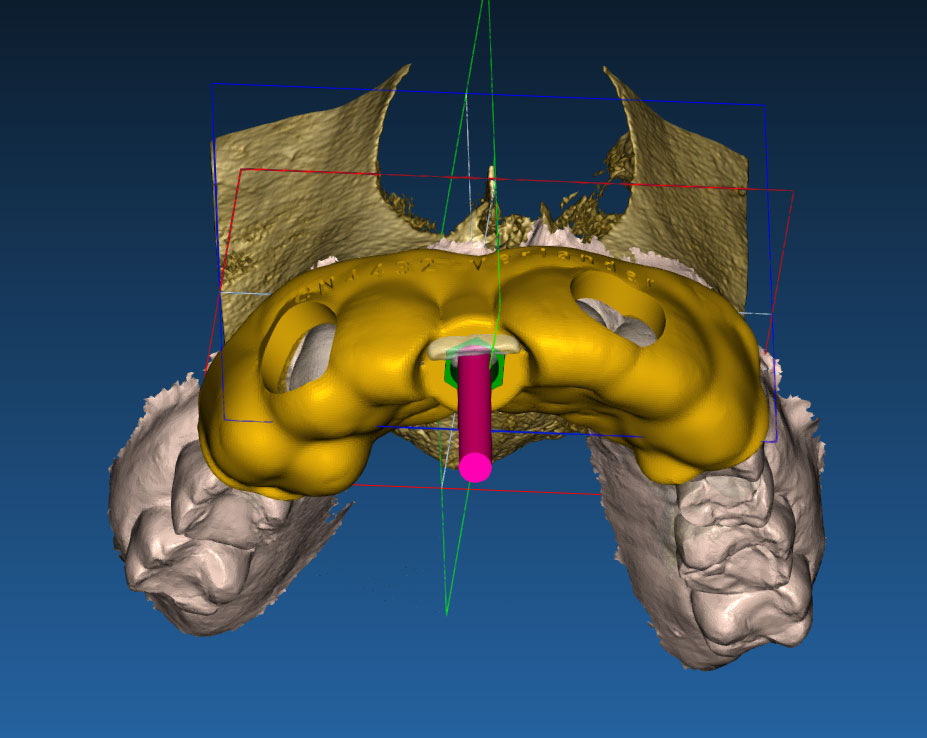 dental implant planning