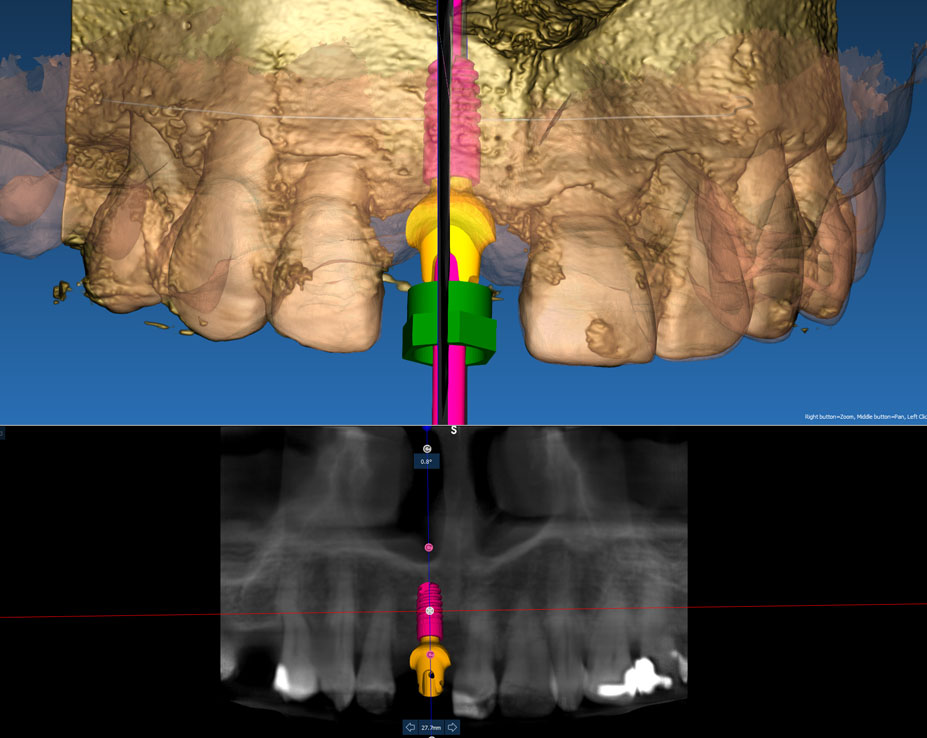 digital dental implant planning