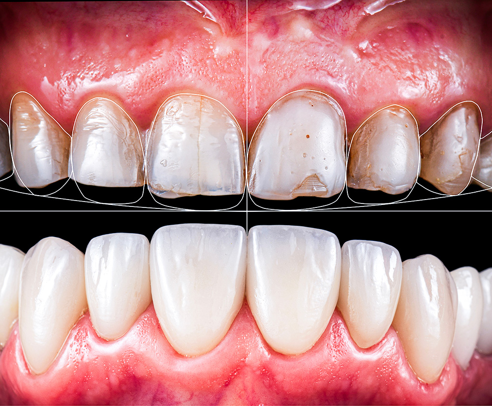 smile design digital dental lab