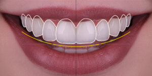The role of a dental implant lab in full mouth restorations
