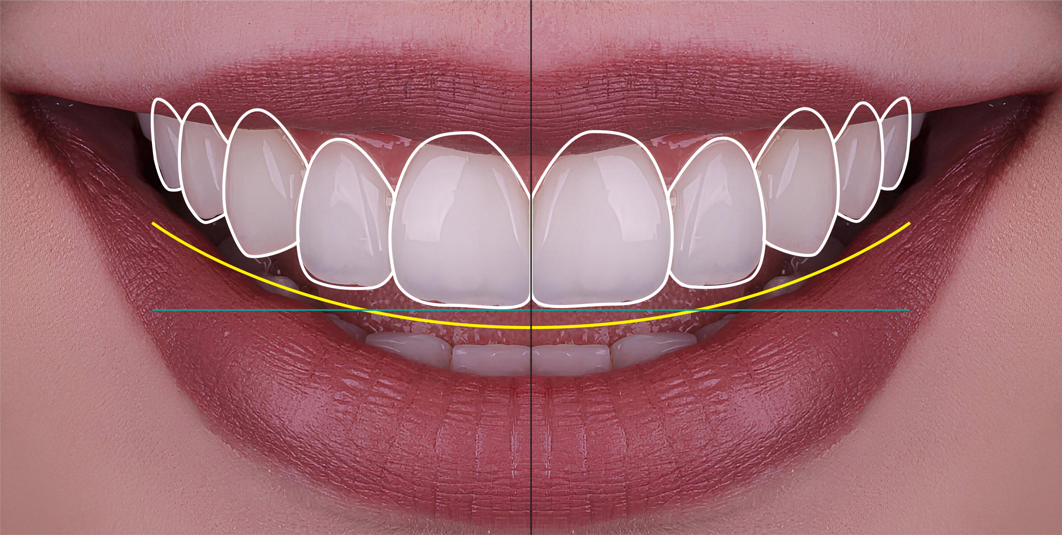 The role of a dental implant lab in full mouth restorations
