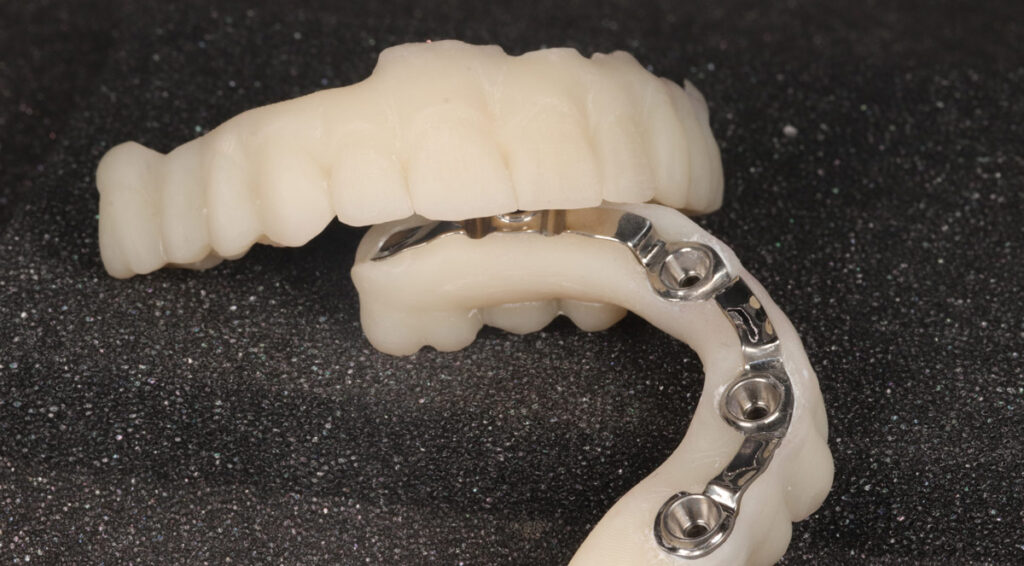 The future of smile restorations