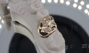 The process of creating custom crowns in a dental lab