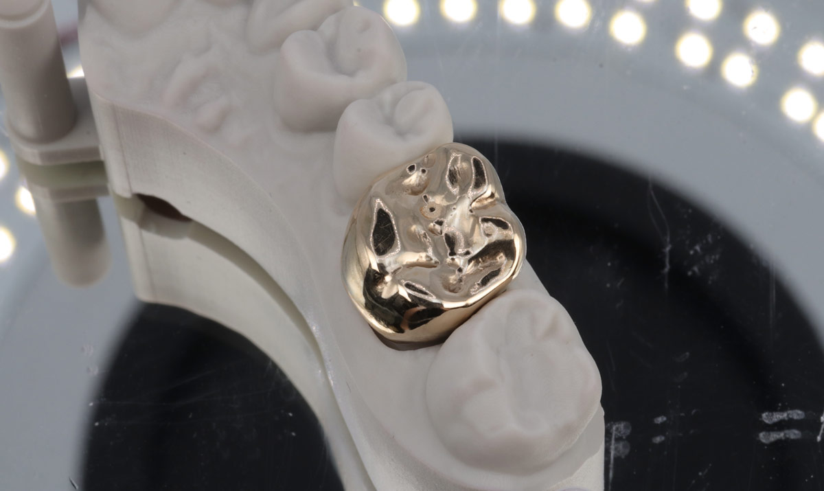 The process of creating custom crowns in a dental lab