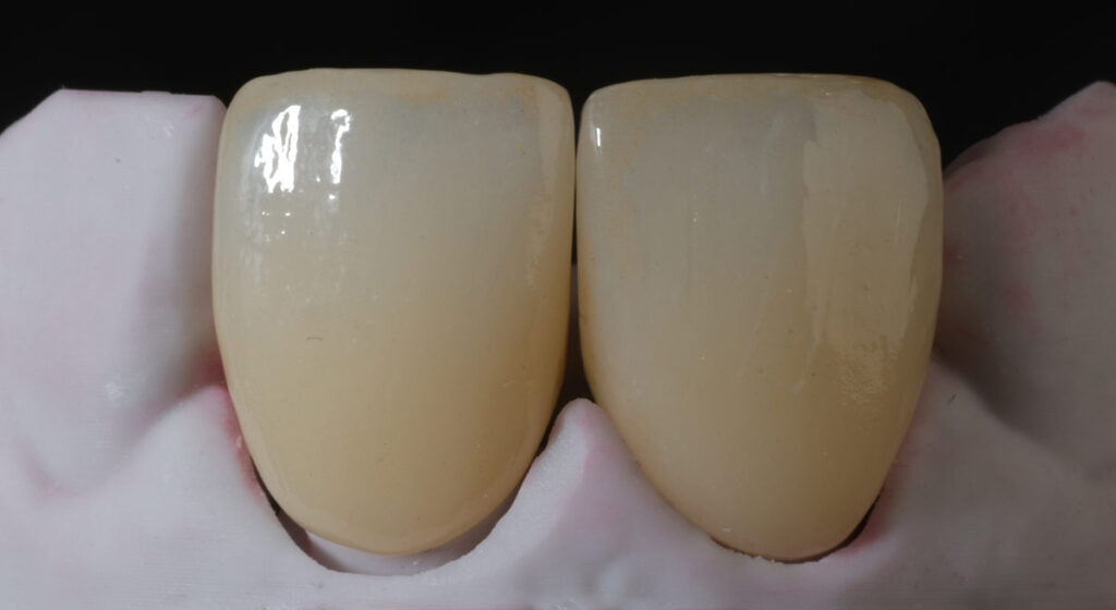 Working with the dentist for final adjustments