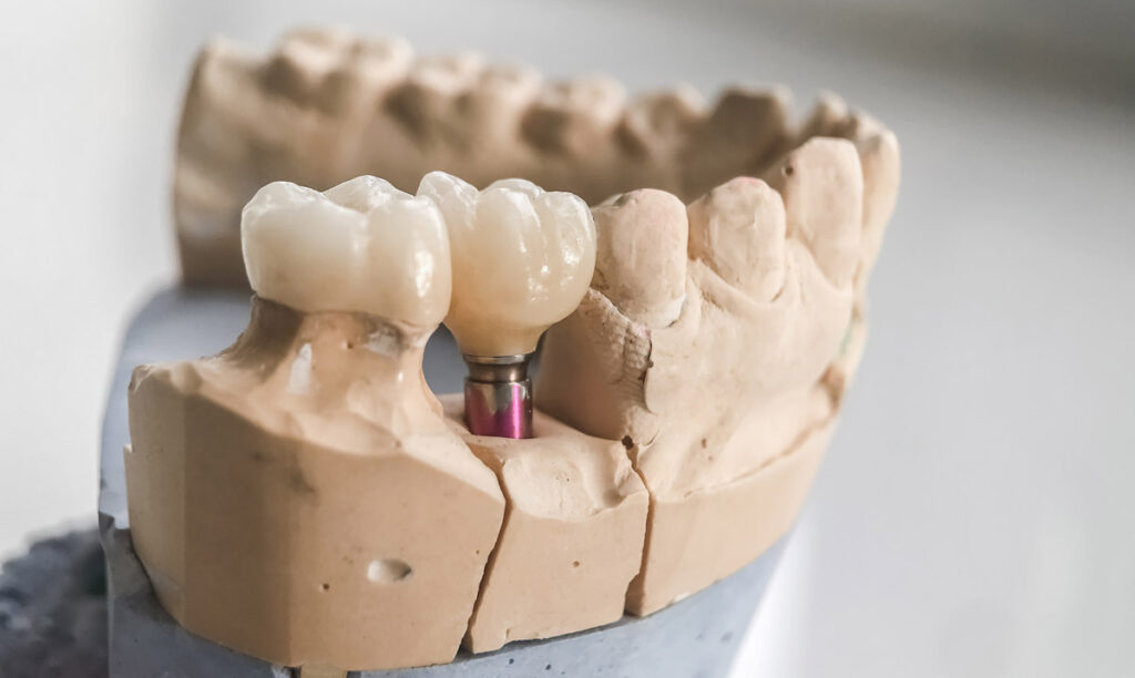 Customisation and precision in restorative work