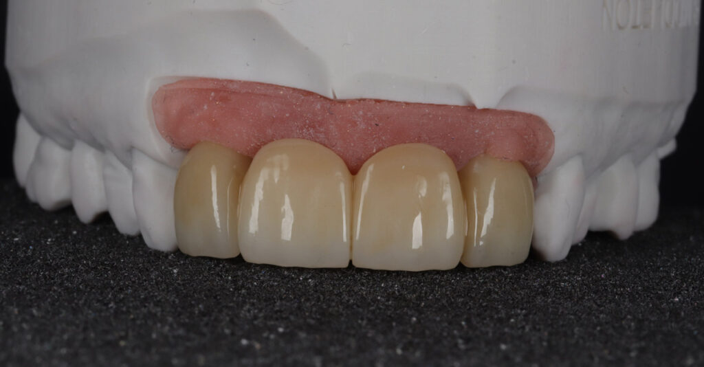 Implant bridge