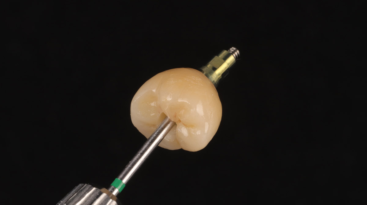 Implant on driver