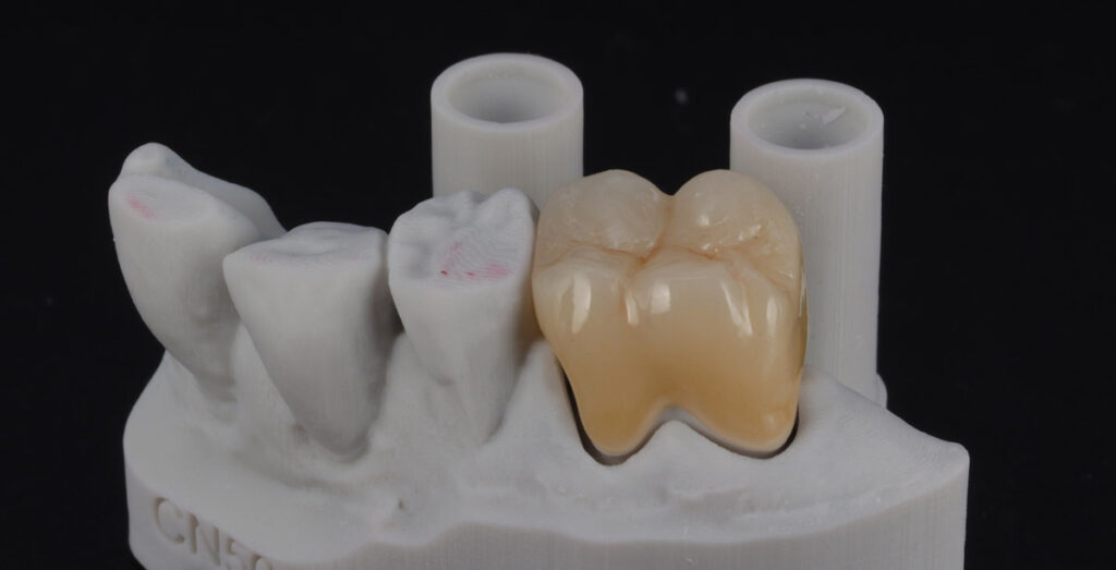 Molar Crown