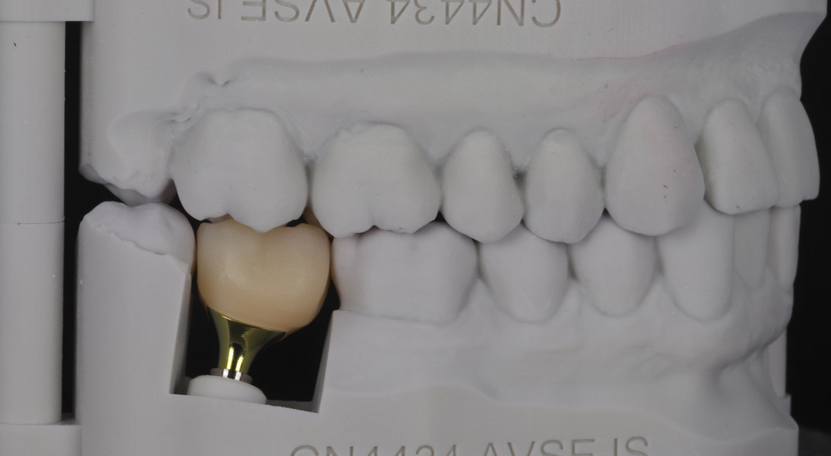 dental implant behind the scenes