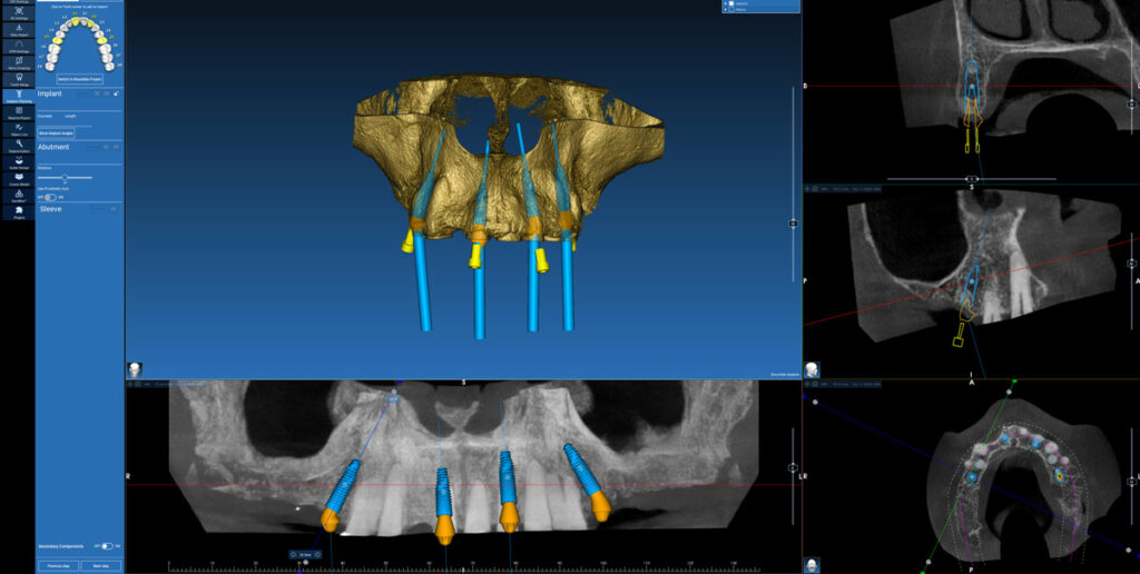 dental laboratories implant planing