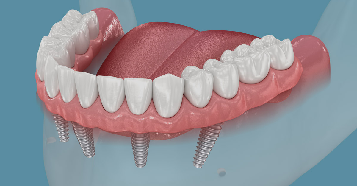 All on 4 dental implant