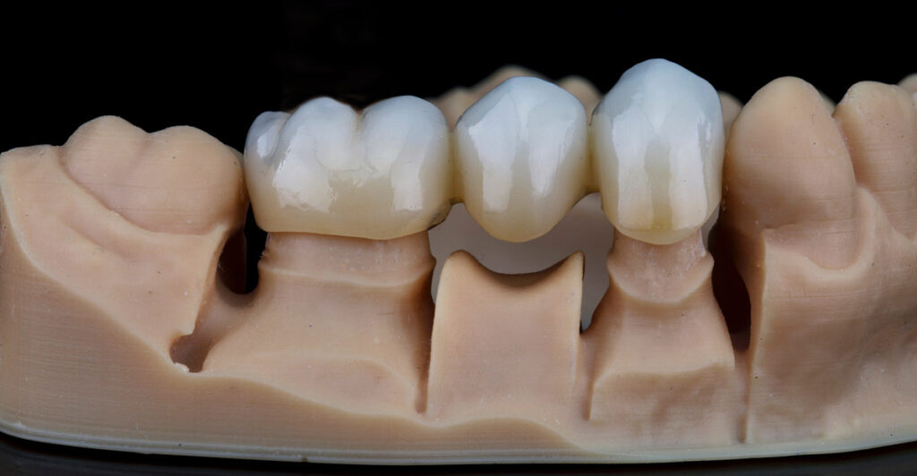 advanced technology and materials dental bridge