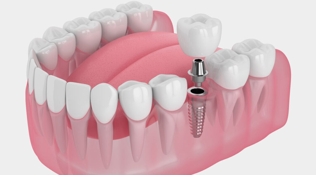 dental implant diagram