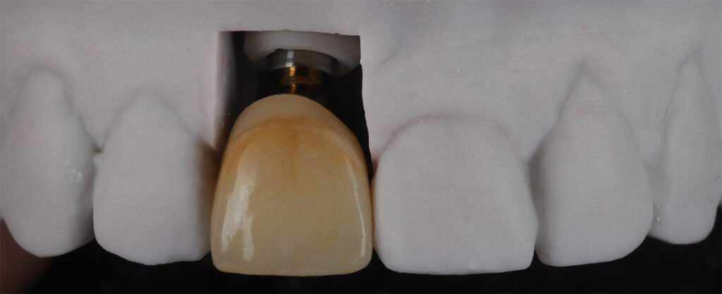 dental implant uk