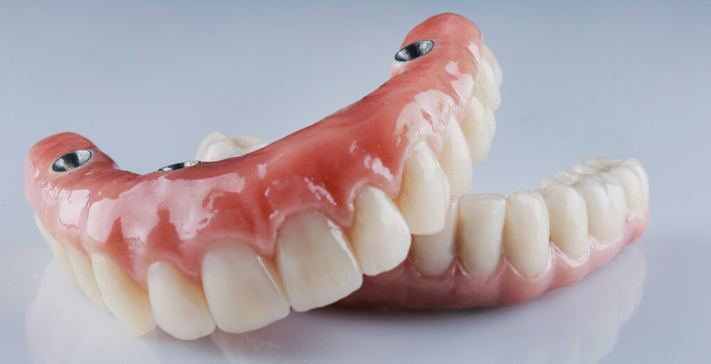 full mouth implant