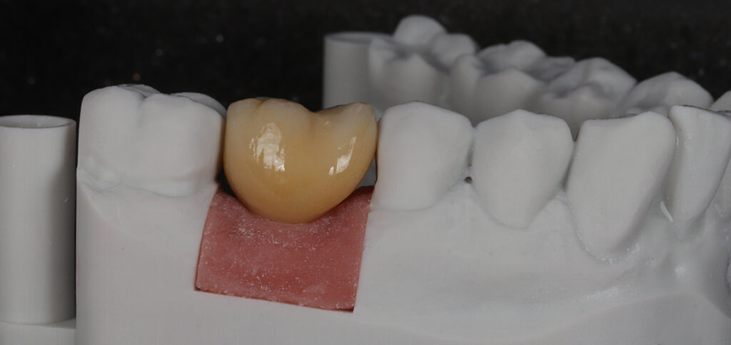low cost dental implants uk molar