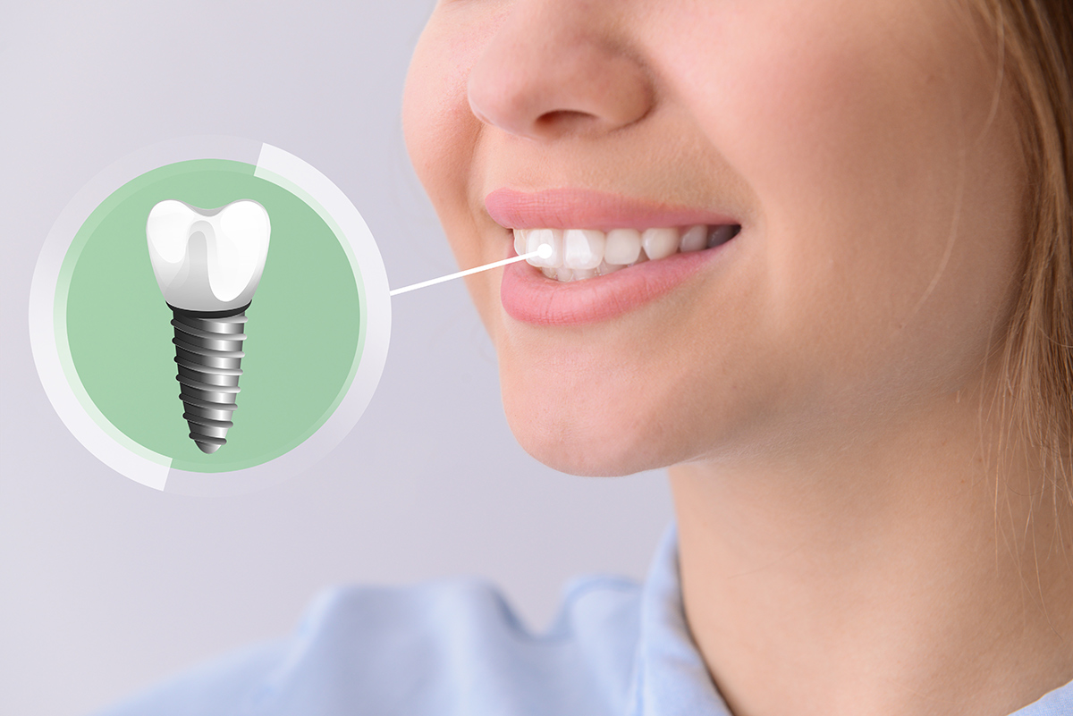low cost dental implants uk