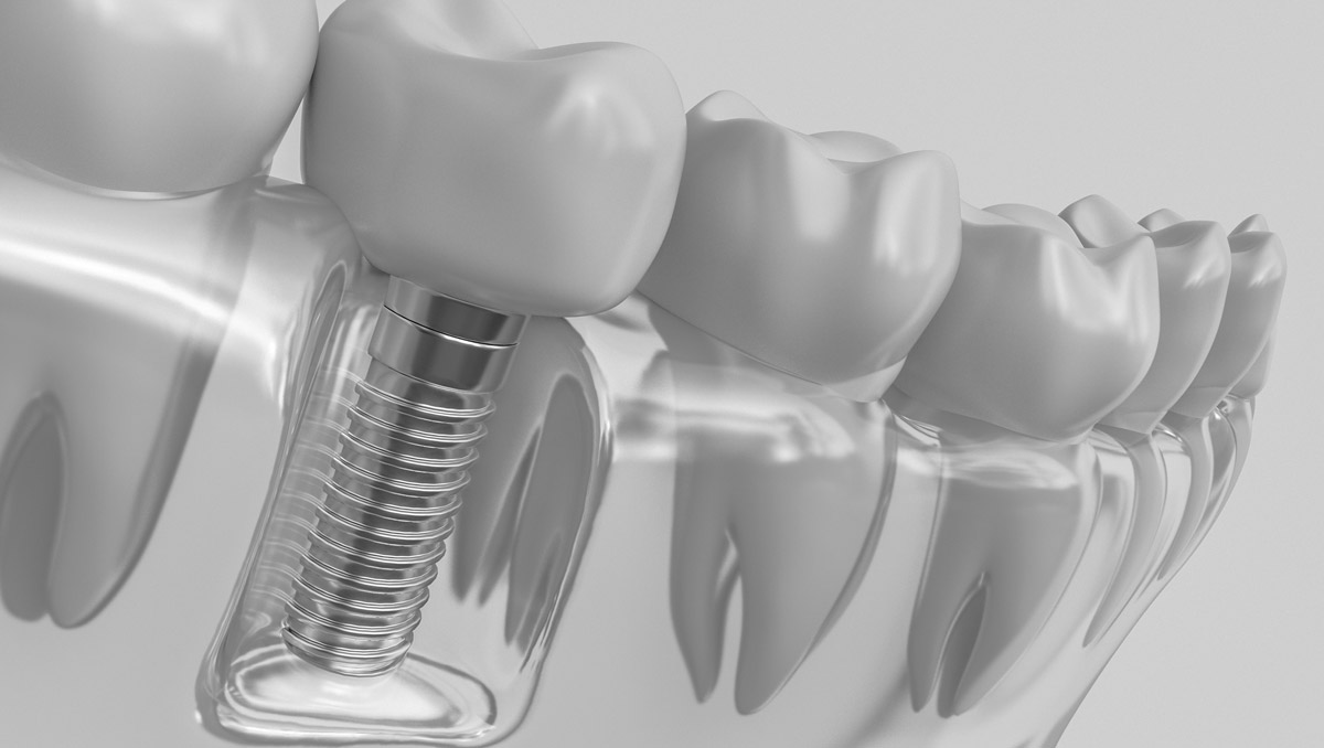 cheap dental implants in England