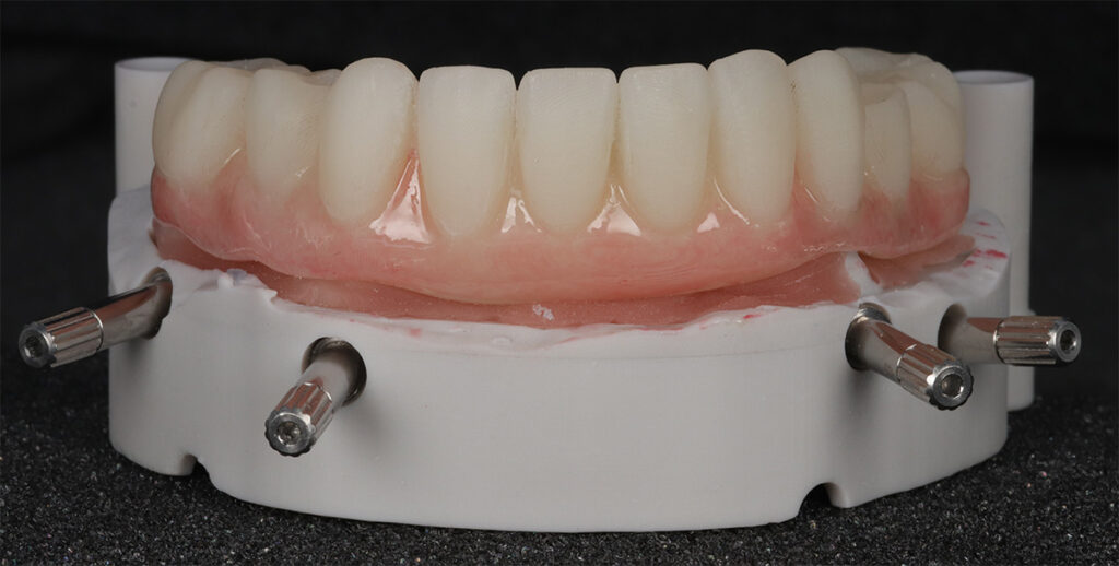cheapest all on 4 implants