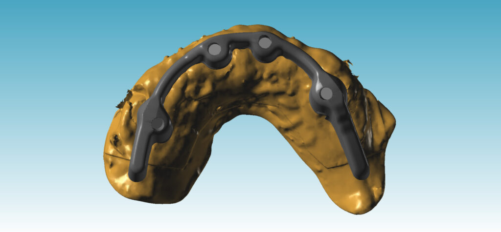 cheapest all on 4 implants plan