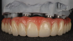 cheapest all on 4 implants uk