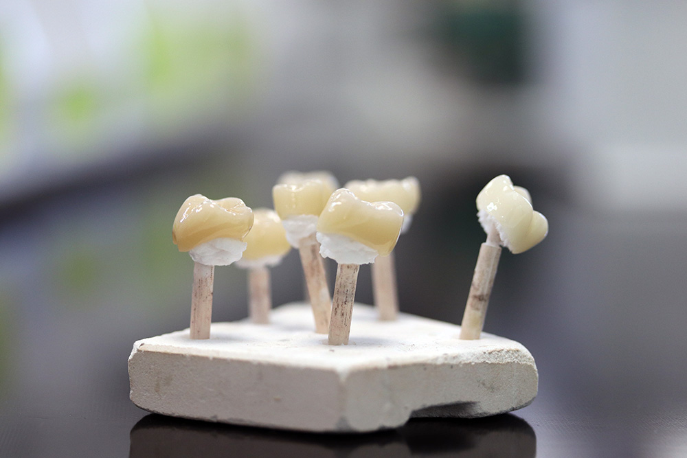 ceramic dental laboratory crowns