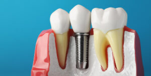 dental implant model best dental implants uk