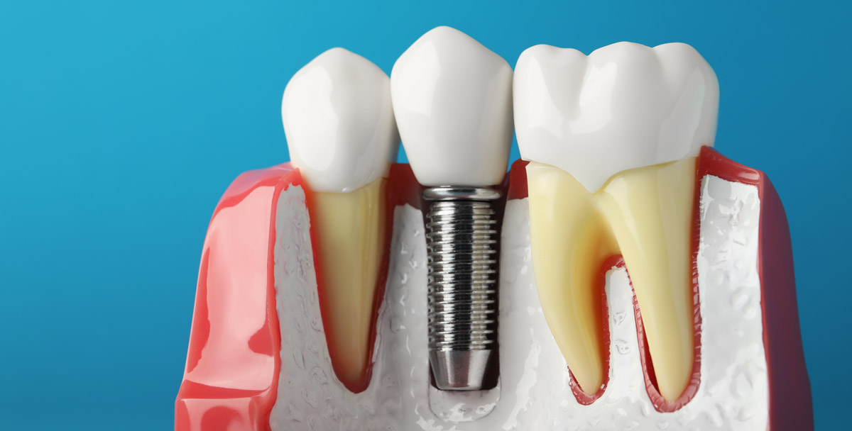 dental implant model best dental implants uk
