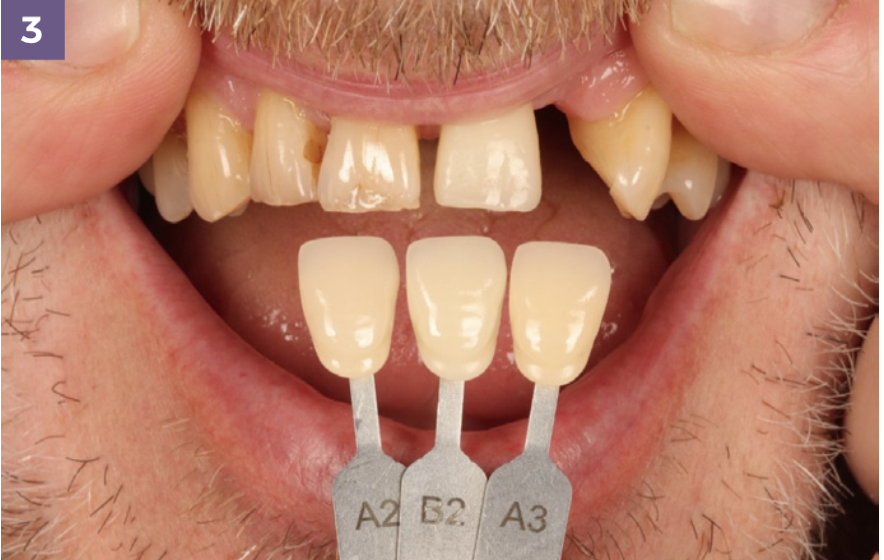 leah potter case overview shade matching 3