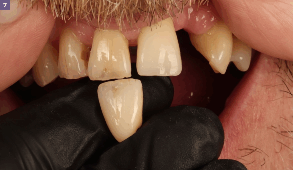 leah potter case overview translucencies on tooth