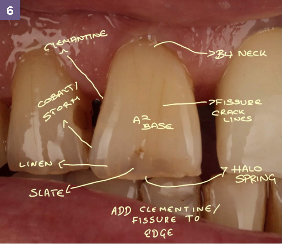 leah potter case overview translucencies on tooth 2