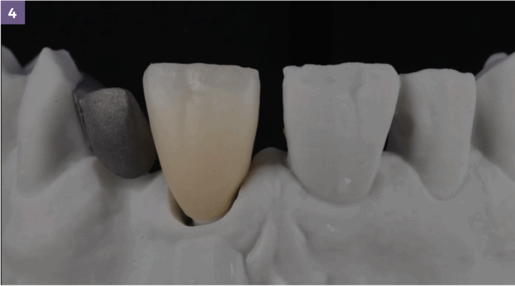 leah potter case overview zirconia process