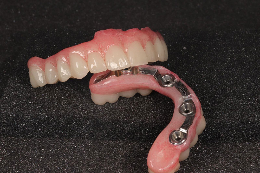 dental lab full arch implant after 10