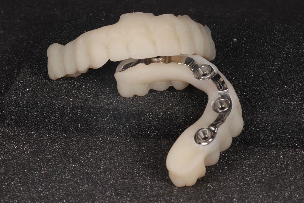 dental lab full arch implant before 10