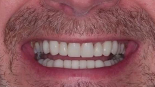 dental lab full mouth rehab after 1