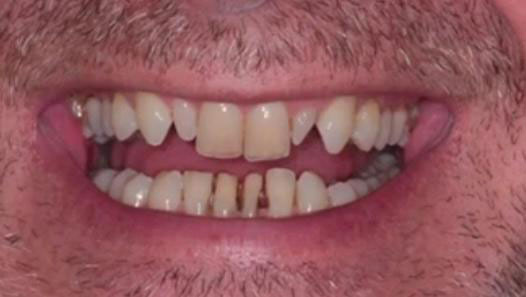 dental lab full mouth rehab before 1