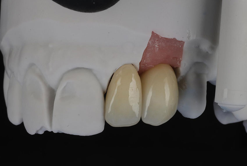 dental lab implant abutment crown after 11