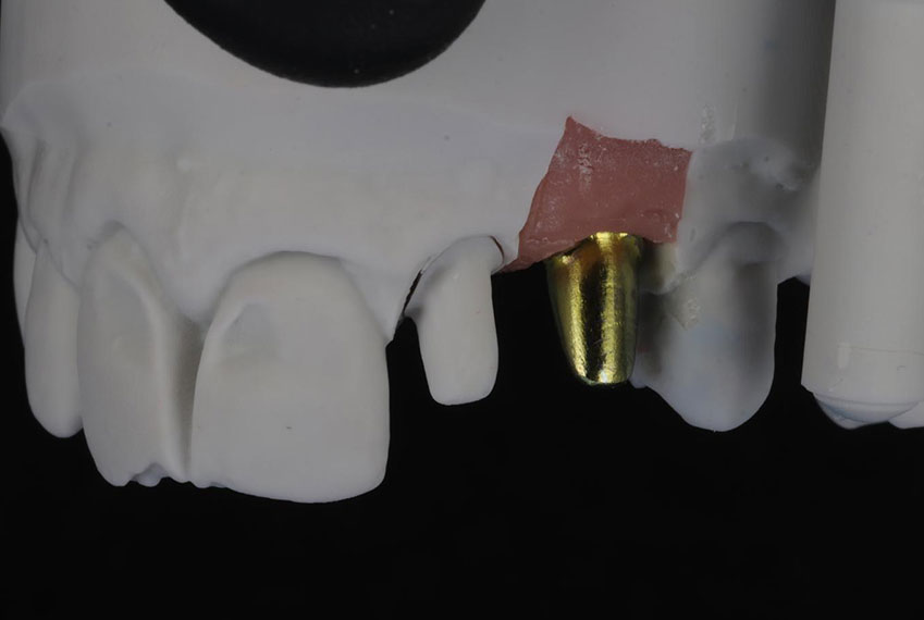 dental lab implant abutment crown before 11