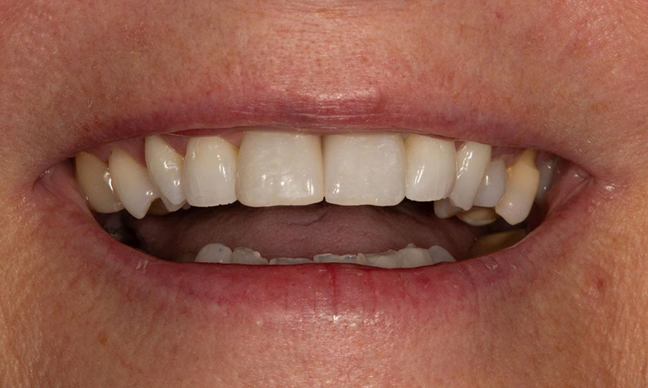 dental lab implant case after 9