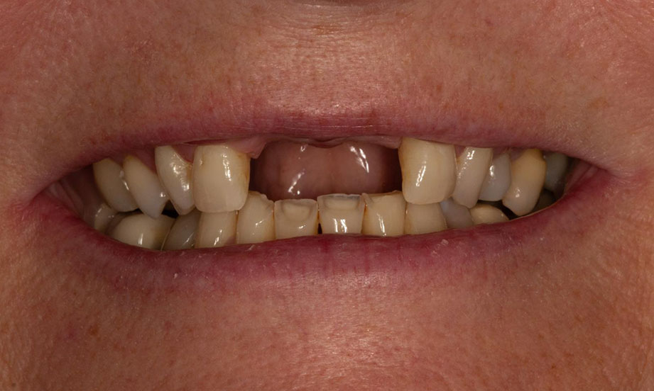 dental lab implant case before 9