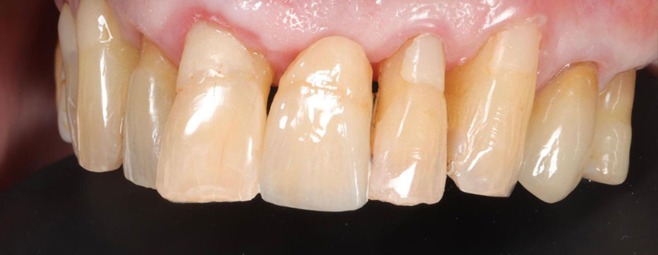 dental lab implant crown after 8