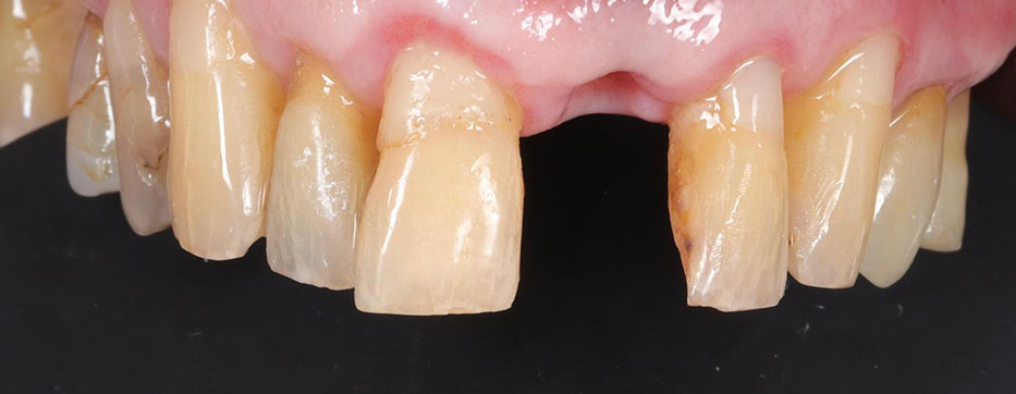 dental lab implant crown before 8
