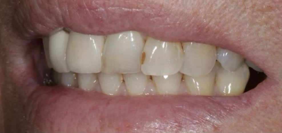 dental lab implant planning after 6