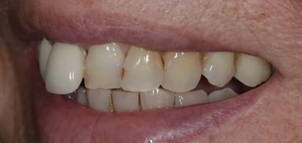 dental lab implant planning before 6