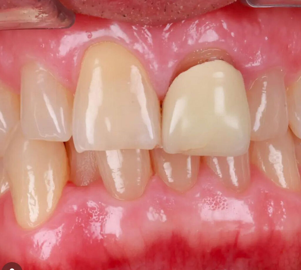 dental lab zirconia crown before 7