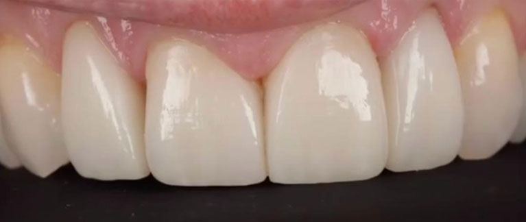 dental lab zirconia crowns after 2