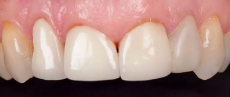 dental lab zirconia crowns before 2