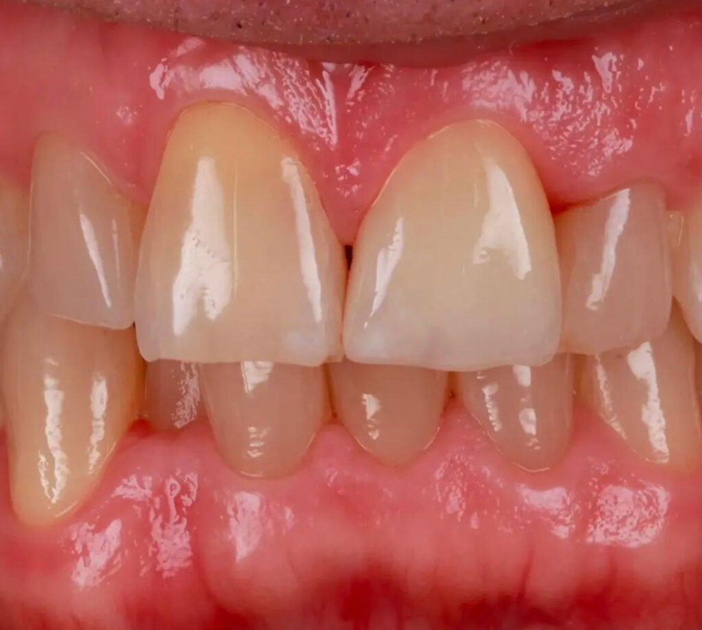 dental laboratory gallery crown after 7